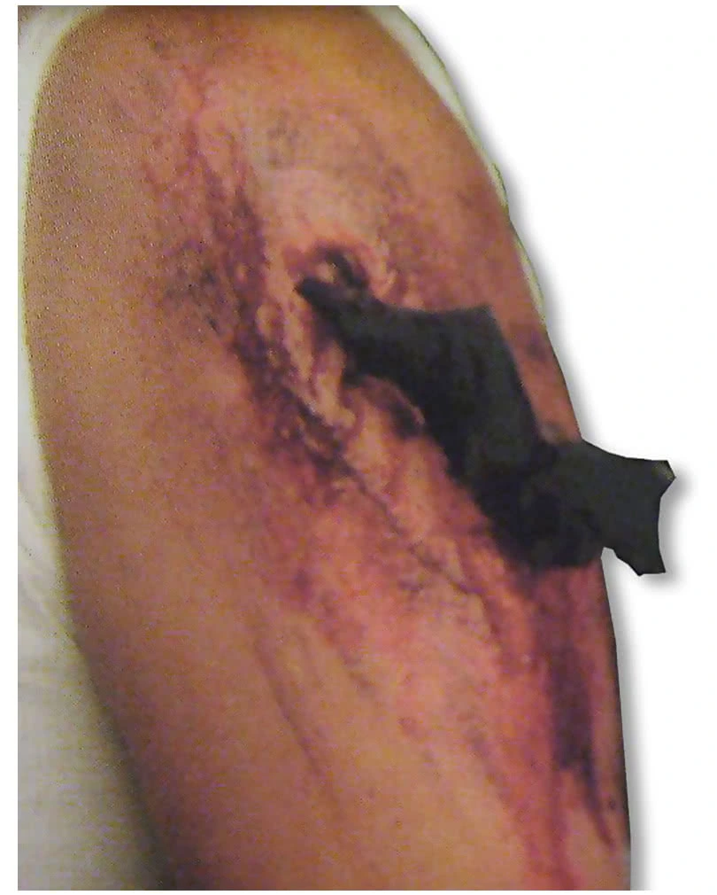 Große Metall Attacke Wunde