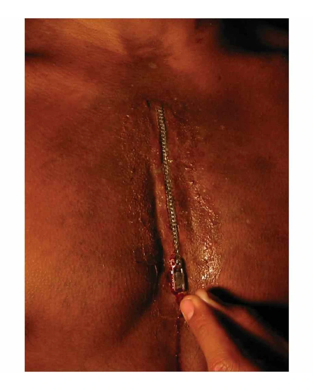 Realistische Zipperwunde